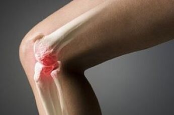 Arthrosis of the knee joint is a lesion of the cartilage tissue