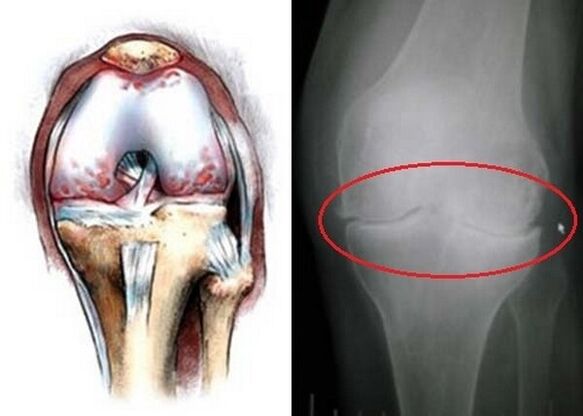 Osteoarthritis of the knee joint